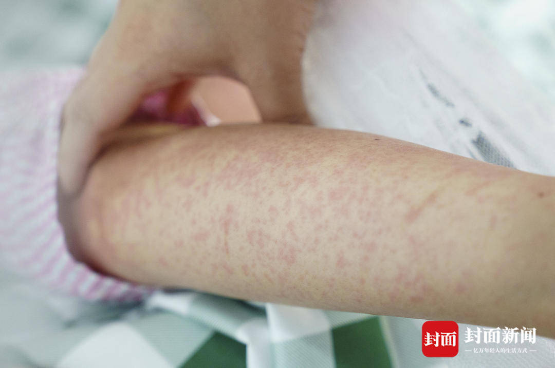 探访佛山基孔肯雅热定点医院：病床上加装了蚊帐，已有近300人治愈出院｜封面头条