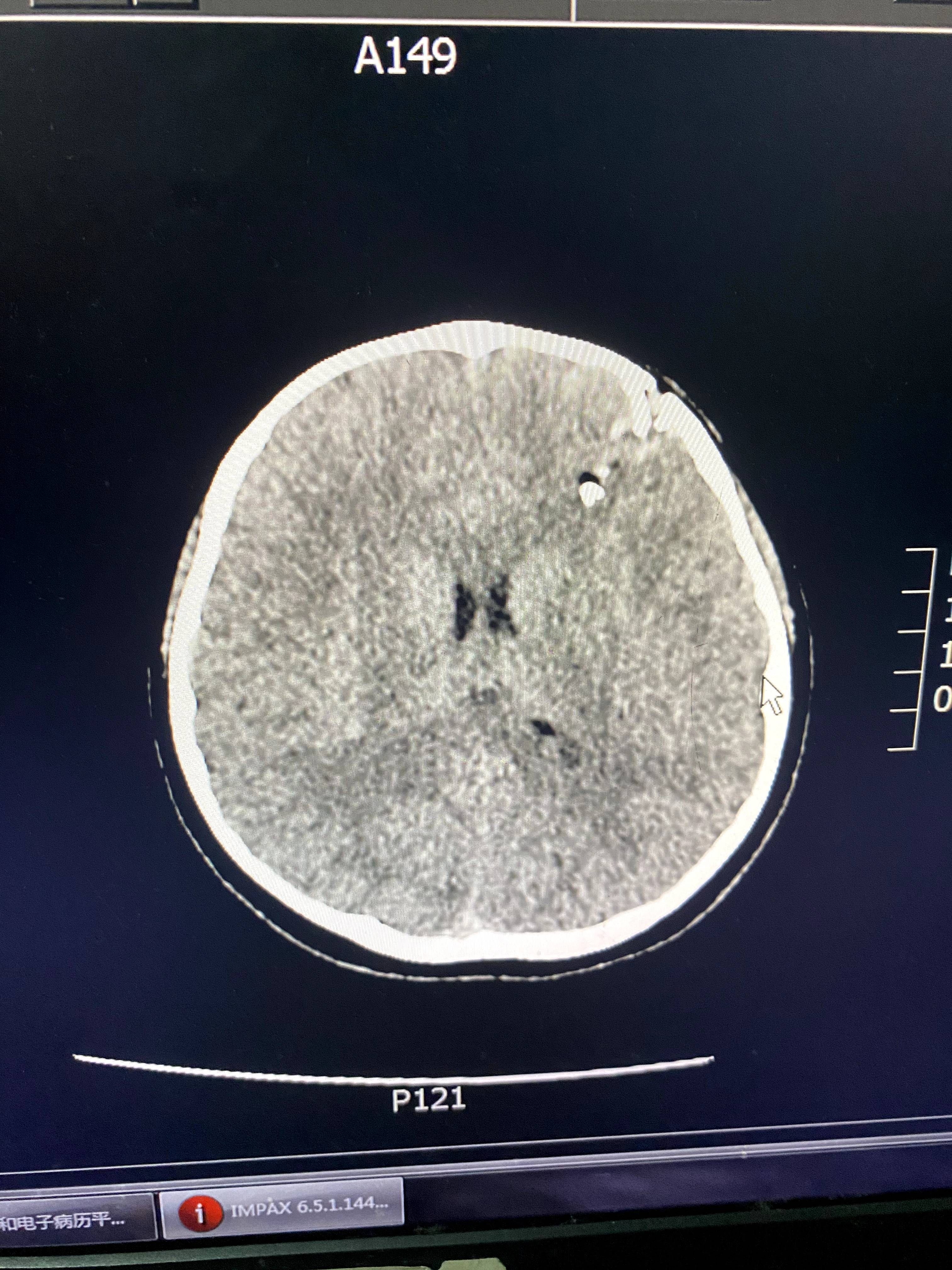 老师打伤学生判五年 学生伤残返校困难